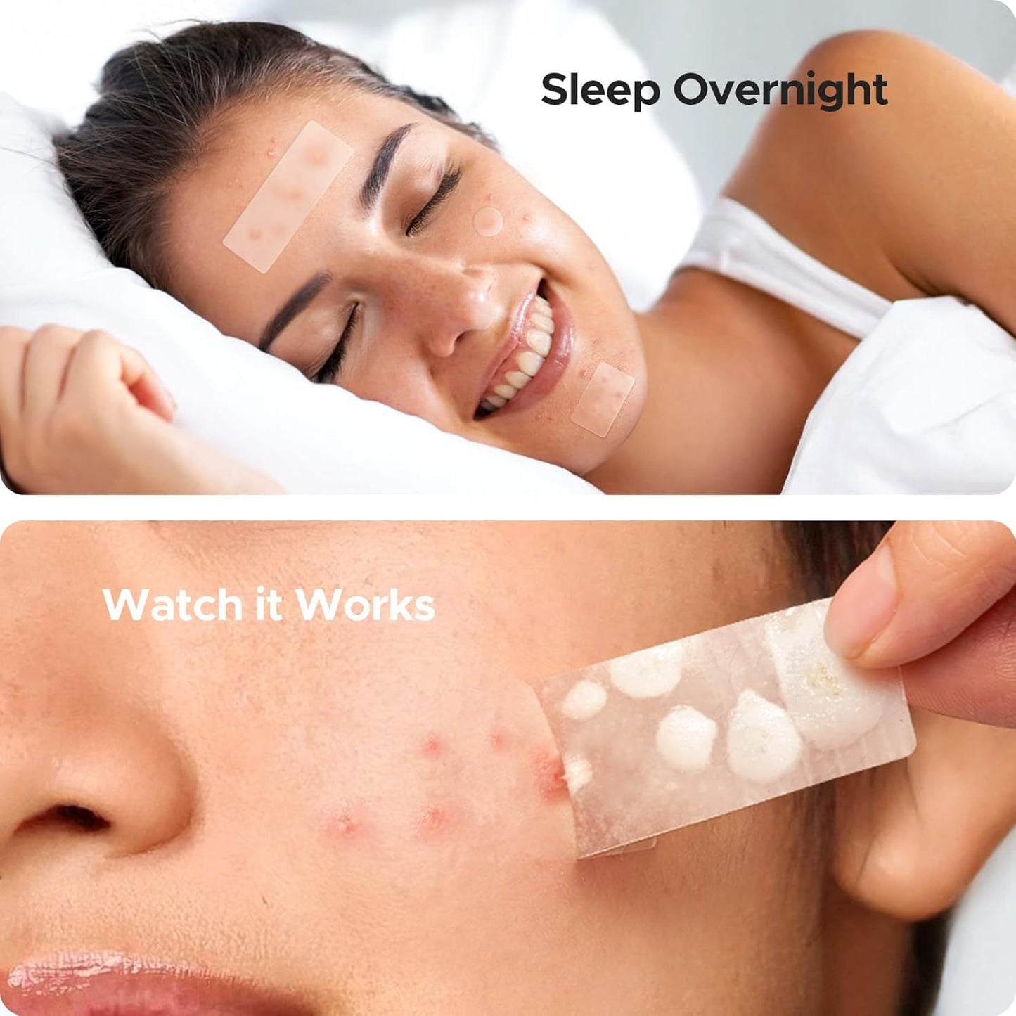 302PCS Invisible Acne Patches – Fast-Healing Spot Treatment for Clearer Skin